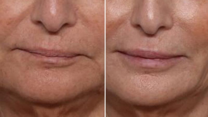Can Supplements Really Cure Actinic Keratosis?