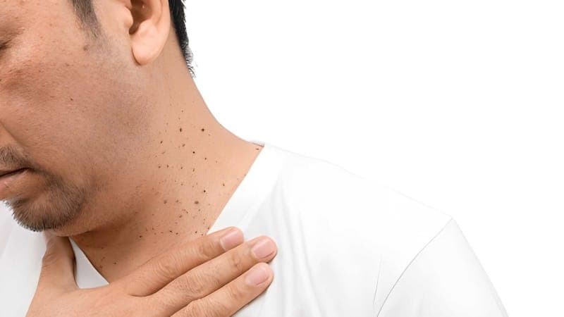 Should You Leave a Skin Tag Alone or Have It Removed?
